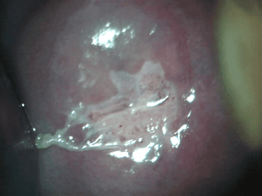 Colo de útero apresentando uma NIC (Neoplasia Intraepitelial Cervical)