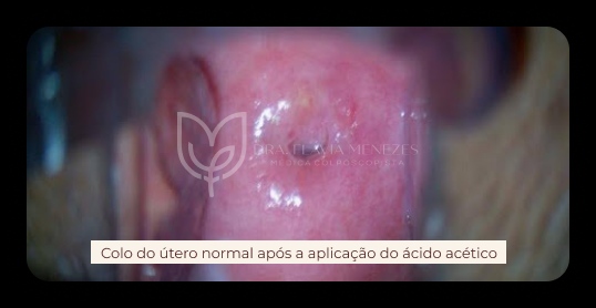 colo de útero normal após aplicação de ácido acético