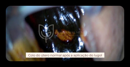 colo de útero normal após aplicação do lugol